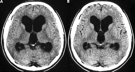 Third Ventricle Mri