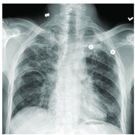 Chest radiograph showing bilateral interstitial-alveolar pattern ...