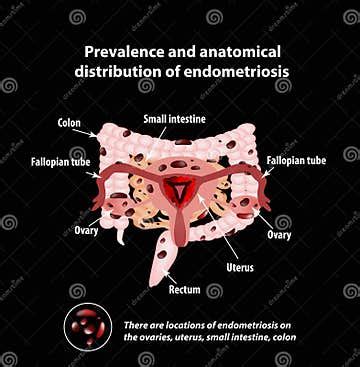 Endometriosis. the Appearance of the Disease . Endometrium. Colon ...