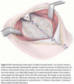 The Treatment Of Incisional Hernia