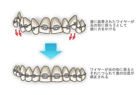 天神歯科・矯正歯科歯列矯正でワイヤーが歯を動かす仕組みとは？ 【公式】福岡の目立たない歯列矯正なら 天神歯科・矯正歯科