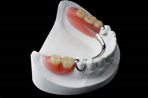 Partial dentures - North Street Dental