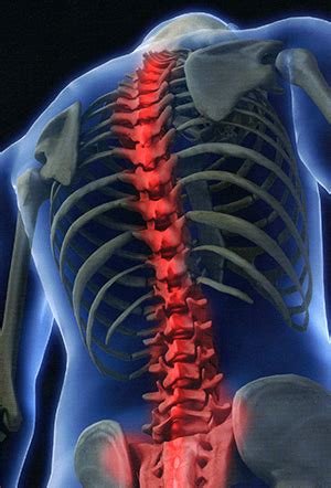 Lesión medular espinal Hospital Nacional de Paraplejicos