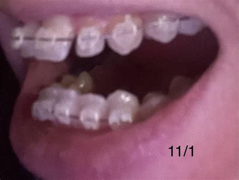 Moving Super Fast Deep Overjet Deep Bite Retruded Bottom Jaw R Braces