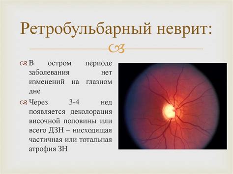 Воспаление зрительного нерва - презентация онлайн