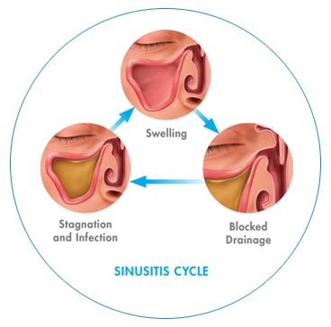 What is the Sinusitis Cycle | NY Center for Sinus Relief