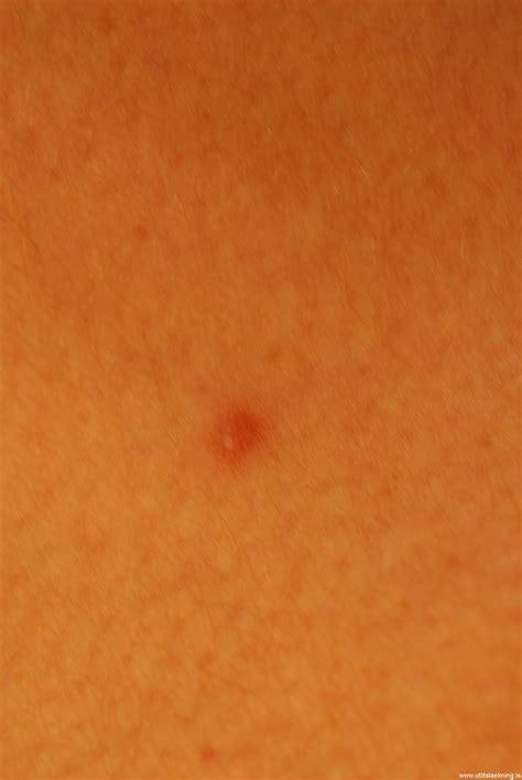 Húðtrefjahnútar (dermatofibroma) - Útlitslækning