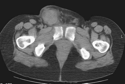 Hemorrhagic Cyst Of The Canal Of Nuck After Vaginal Delivery Presenting