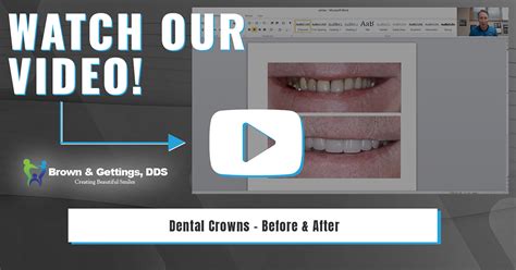 Dental Crowns - Before And After – Drs. Brown, Gettings & Gade - West Chester, OH Dentists