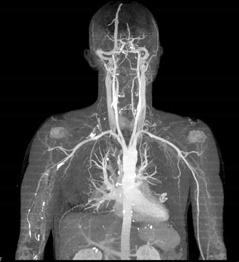 Normal Cta Of The Neck Neuro Case Studies Ctisus Ct Scanning