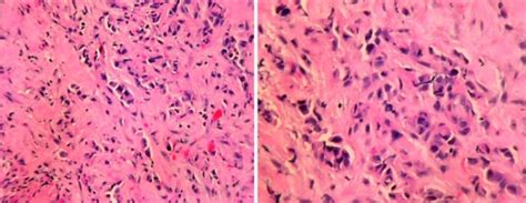 Core Biopsy Of Left Cervical Lymph Node Demonstrating Fibrous Tissue Download Scientific