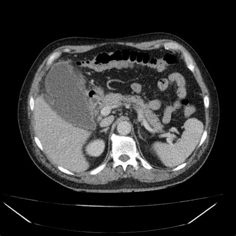 Acute Cholecystitis – Core EM