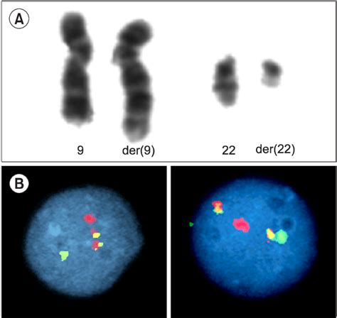 A Karyotype Showing T Q Q Philadelphia Translocation B