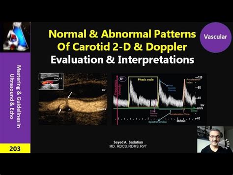 Carotid Doppler Ultrasound