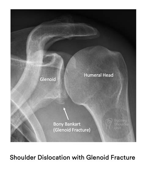 Labral Tears Dr Pant Sydney Shoulder Unit