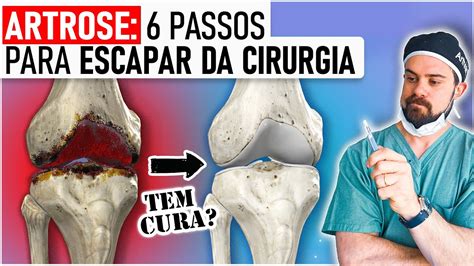 Artrose Tem Cura Como Prevenir E Tratar Sem Cirurgia Aula C