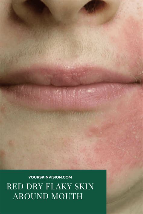 Red Dry Flaky Skin Around Mouth Causes And Treatment