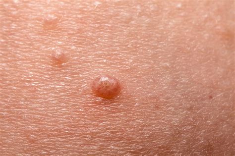 Molluscum Contagiosum Wart Treatment In Nw Dc Gz Skin And Face