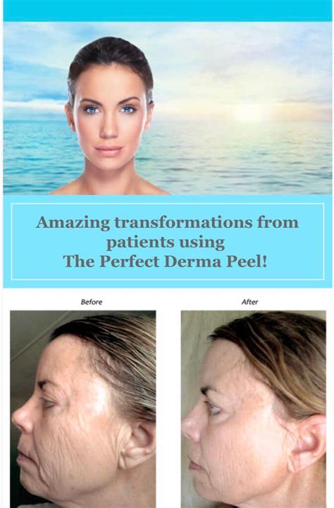 The Perfect Derma Peel Chemical Peel For All Skin Types