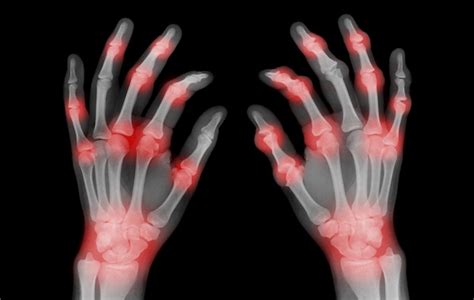 Get a handle on arthritis pain with specialized wrist and hand treatments | Plastic Surgery | UT ...