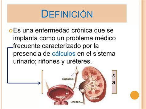 Litiasis Renal Ppt