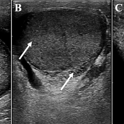 Significant Improvement Of Epididymitis In A B And C Arrows Only