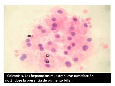 Patologias Hepaticas PPT