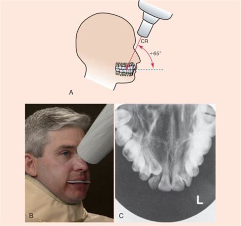 Dhy Ch Occlusal Technique Flashcards Quizlet