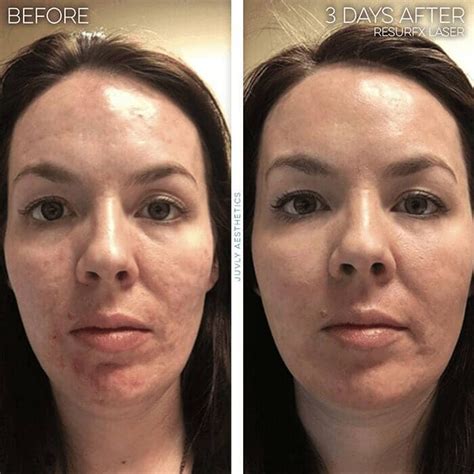 Juvly Aesthetics Resurfx Laser For Skin Resurfacing