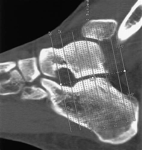 Fractures Of The Calcaneus A Review With Emphasis On Ct Radiographics