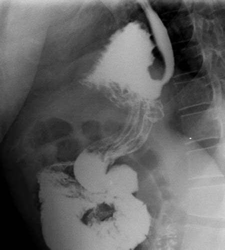 Hiatus Hernia Image Radiopaedia Org