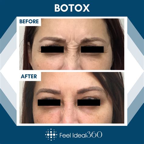 Botox Before And After Neuromodulator Feel Ideal 360 Med Spa