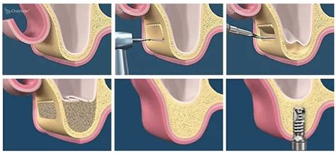 Sinus Augmentation Pinellas Oral Surgery And Implant Center