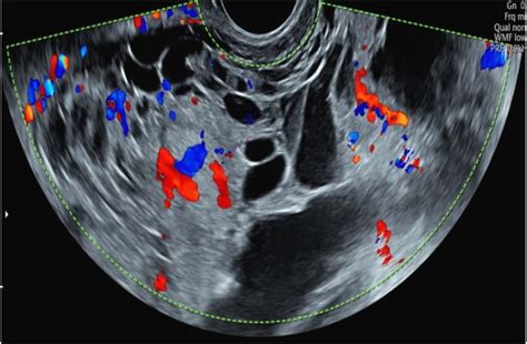 Ultrasound Assessment With Endovaginal Download Scientific Diagram