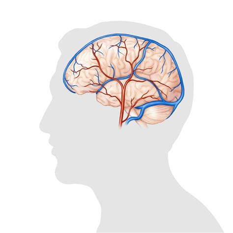 Dural Arteriovenous Fistula Davf Toronto Neurovascular Group