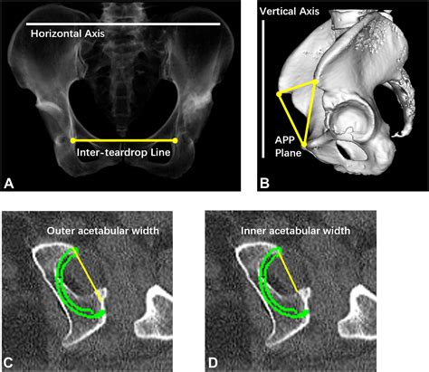 Acetabular Diameter Assessment And Three Dimensional Simulation For