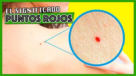 QuÉ Significan Los Puntos Rojos Que Salen En La Piel