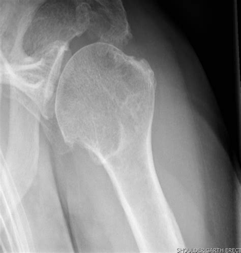 Shoulder Xrays The Bone School