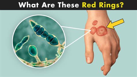 Ringworm Disease Tinea Symptoms Causes And Treatment Urdu Hndi