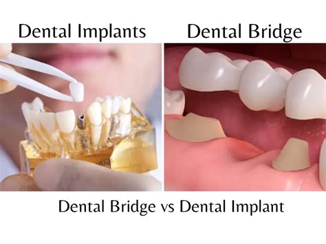 Dental Bridge vs Implant: Uses & When to Pick One?