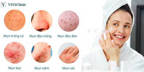 Các loại mụn trên mặt nhận biết và cách điều trị VITA Clinic