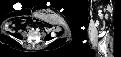 Rectus Sheath Hematoma Associated With The Mynx Vascular Closure Device