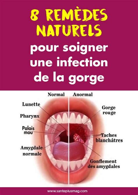 Rem Des Naturels Pour Soigner Une Infection De La Gorge Rem Des