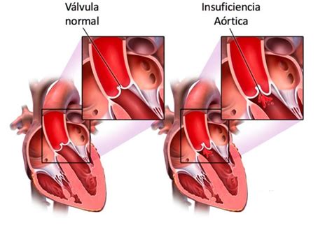 Insuficiencia Aórtica Los mejores Cirujanos de Corazón en México