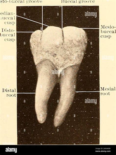 Principles And Practice Of Operative Dentistry Mesio Lingual Cuspfig