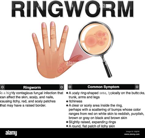 Informative Symptoms Of Ringworm Illustration Stock Vector Image Art