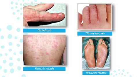 Dermatitis Reaccionales Ppt