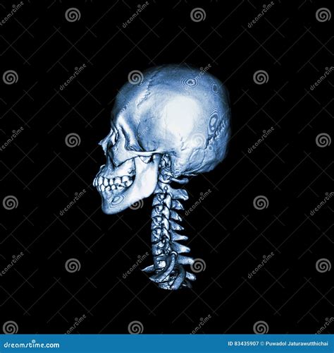 CT Scan With 3D Image Of Normal Human Skull And Cervical Spine Lateral