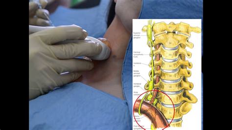 Stellate Ganglion Block For PTSD A Short Video YouTube