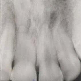 Intraoral Periapical Radiograph Showing An Inverted Impacted